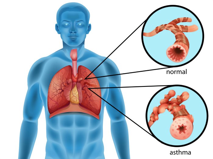 ¿Qué es el asma y por qué aparece?
