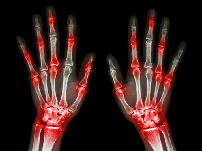 ¿Es lo mismo la artritis que la artrosis?