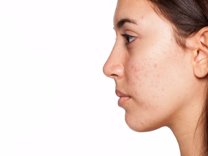 Tipos de acné