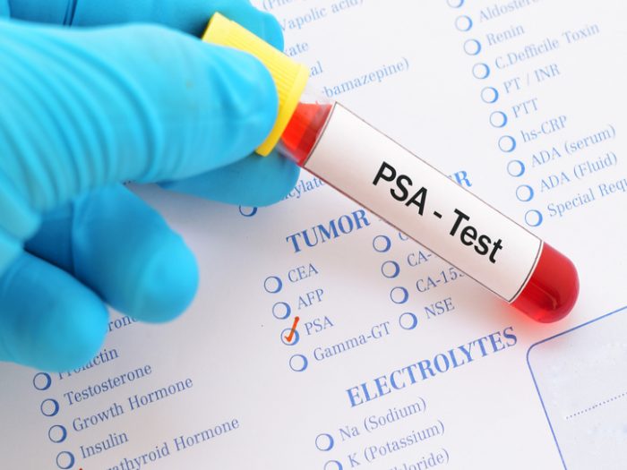 Qué es el PSA, un PSA alto ¿siempre es sinónimo de cáncer de próstata?